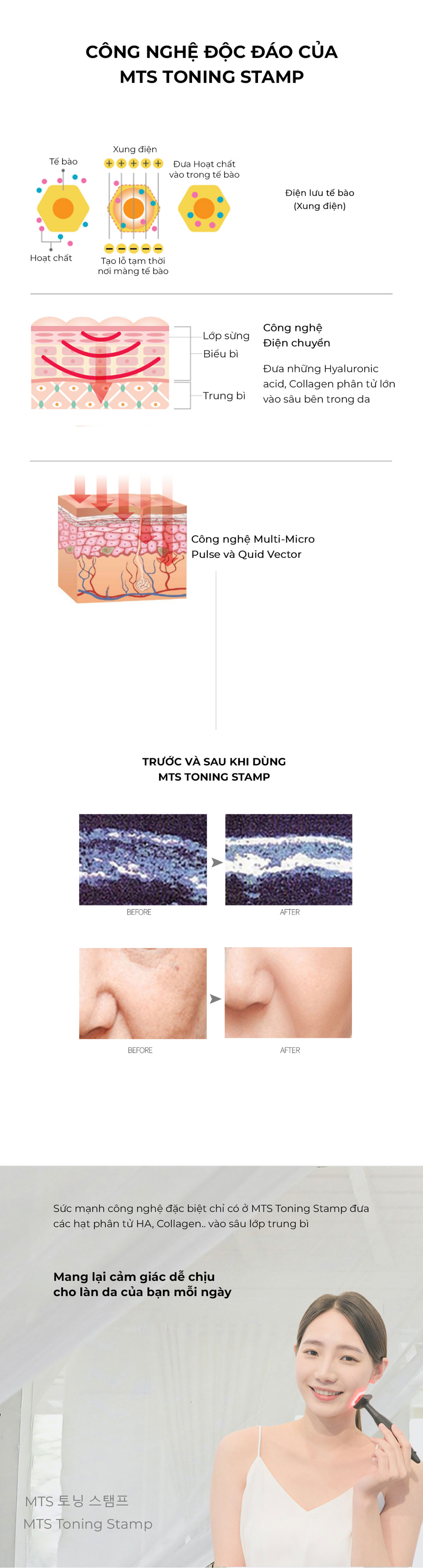 MTS Toning Stamp - Máy điện kim truyền dẫn nhân bào