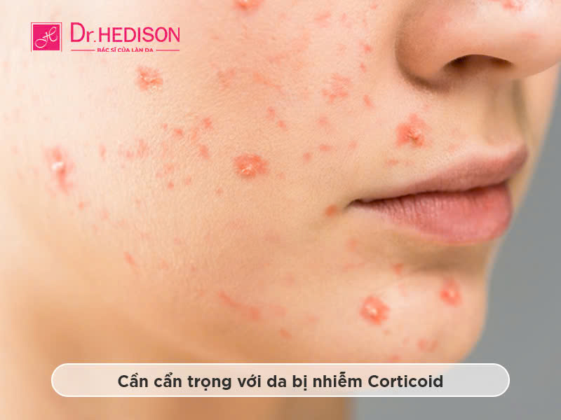 Da nhiễm Corticoid: Dấu hiệu nhận biết và cách phục hồi hiệu quả