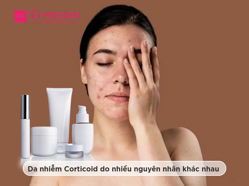 Da nhiễm Corticoid: Dấu hiệu nhận biết và cách phục hồi hiệu quả