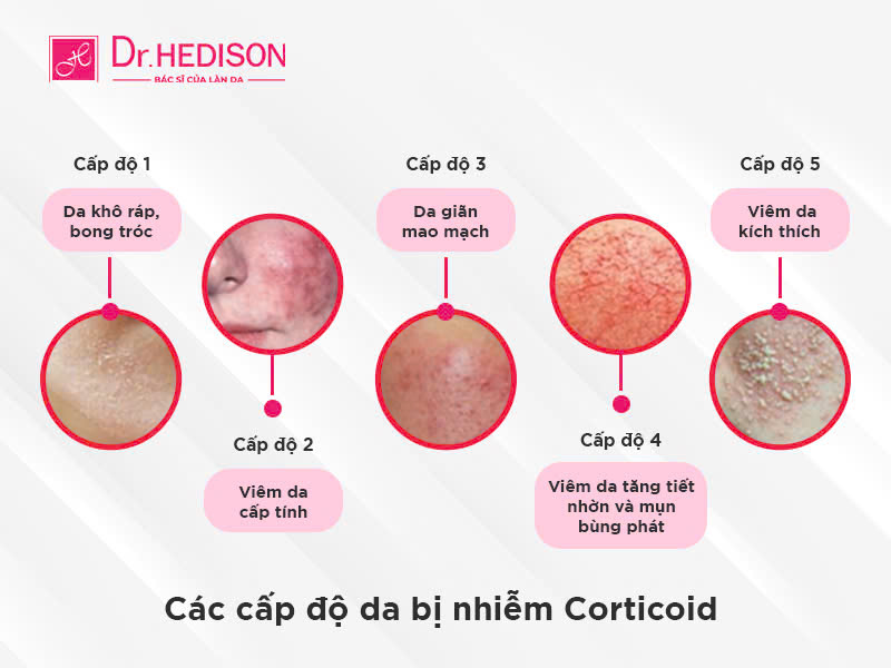 Da nhiễm Corticoid: Dấu hiệu nhận biết và cách phục hồi hiệu quả