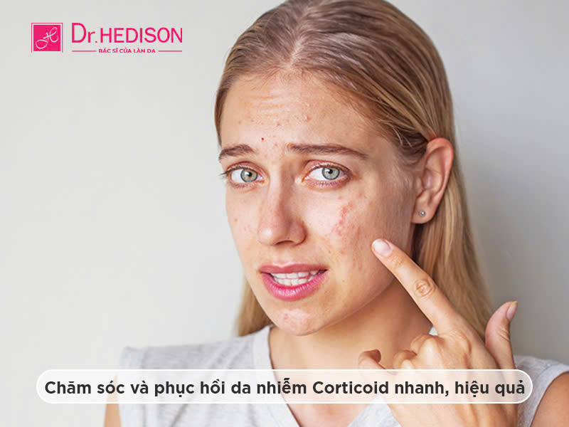 Da nhiễm Corticoid: Dấu hiệu nhận biết và cách phục hồi hiệu quả