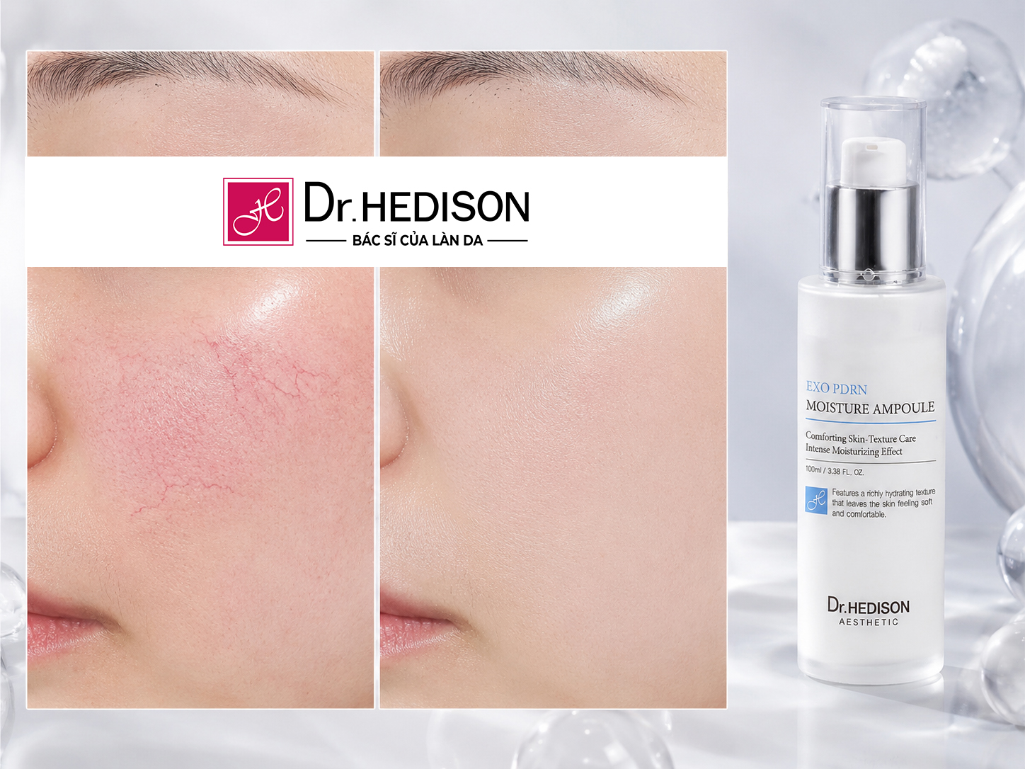 Dr.HEDISON tinh chất Exo PDRN