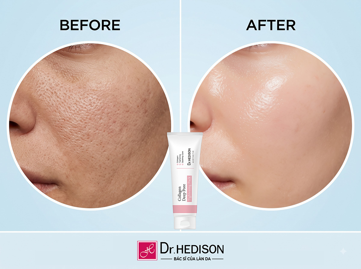 HEDISON Collagen Deep Pore Tightening Pack